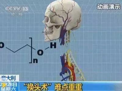 世界首例換頭手術(shù)成功，這事你怎么看？
